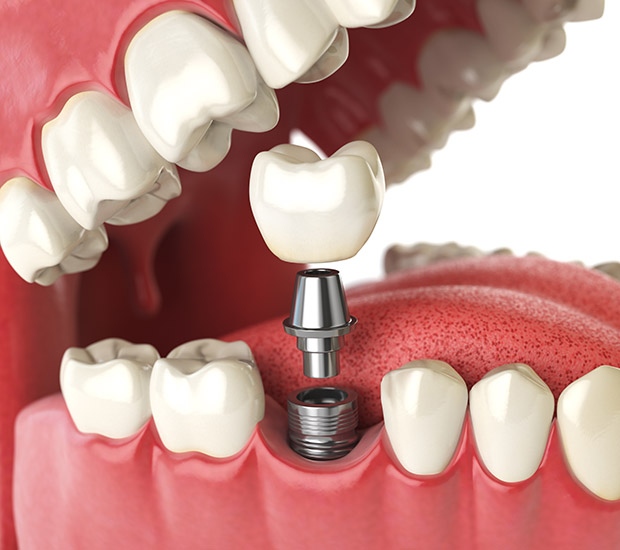 Houston Will I Need a Bone Graft for Dental Implants