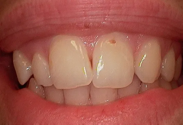 Before INVISALIGN & LUMINEERS