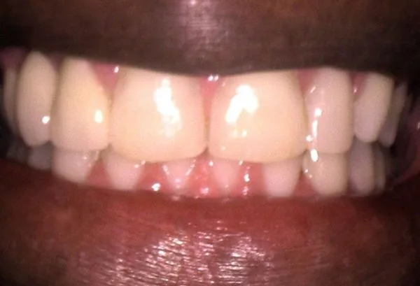 After INVISALIGN & BRIDGES