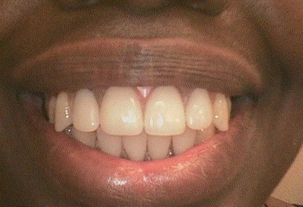 After PARTIALS & DENTURES