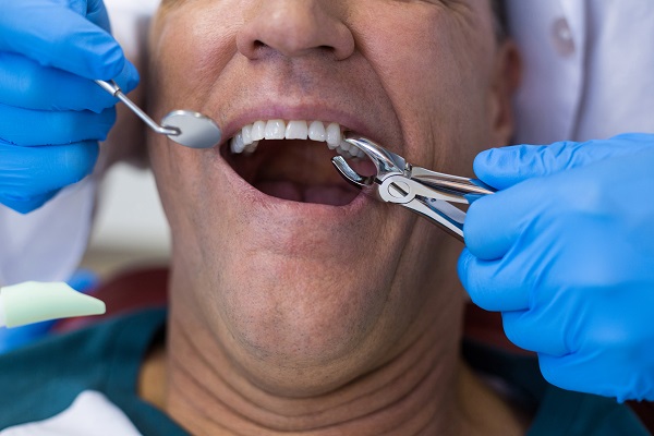 Tooth Extraction Houston, TX